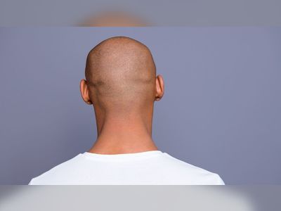Calling a man bald is sexual harassment, employment tribunal rules